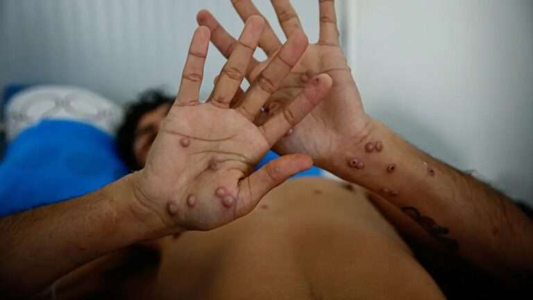 Viruela del mono: “El primer síntoma es una erupción cutánea, pero otros pueden presentar síntomas diferentes”, según docente de la UNVM